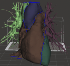 Pre-operative planning